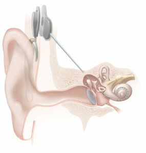 Abbildung Cochlea Implantat